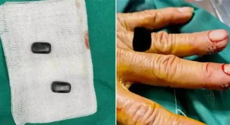 Se implantó imanes en los dedos